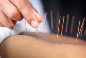 acupuncture