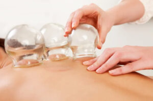 cupping therapy